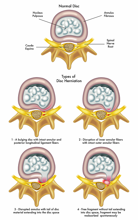 Types of disc herniation