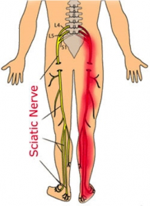 sciatica